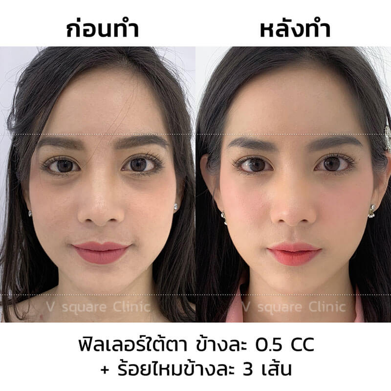 รีวิวร้อยไหมก้างปลา