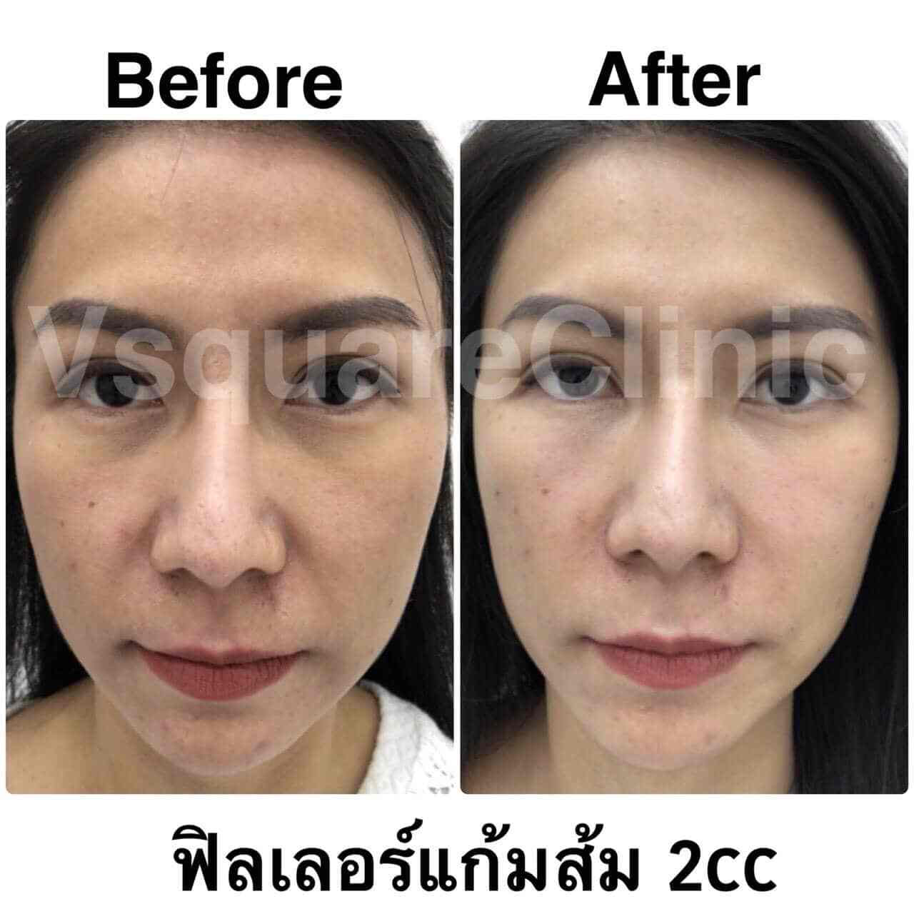 ภาพรีวิวฉีดฟิลเลอร์แก้มส้ม-แก้ไขปัญหาแก้มตอบ