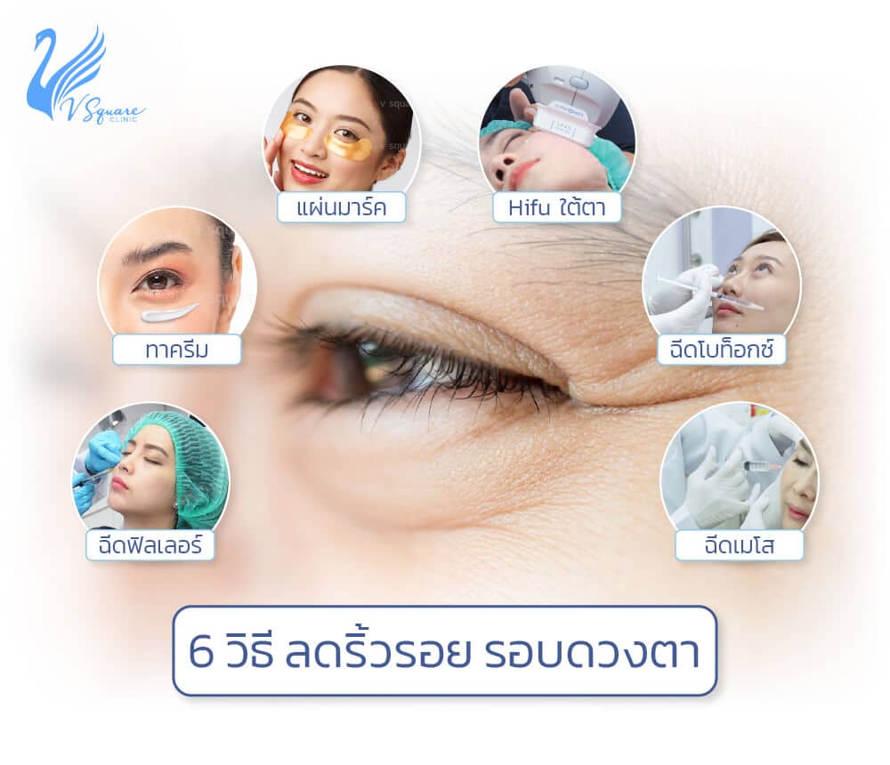 ริ้วรอยใต้ตา