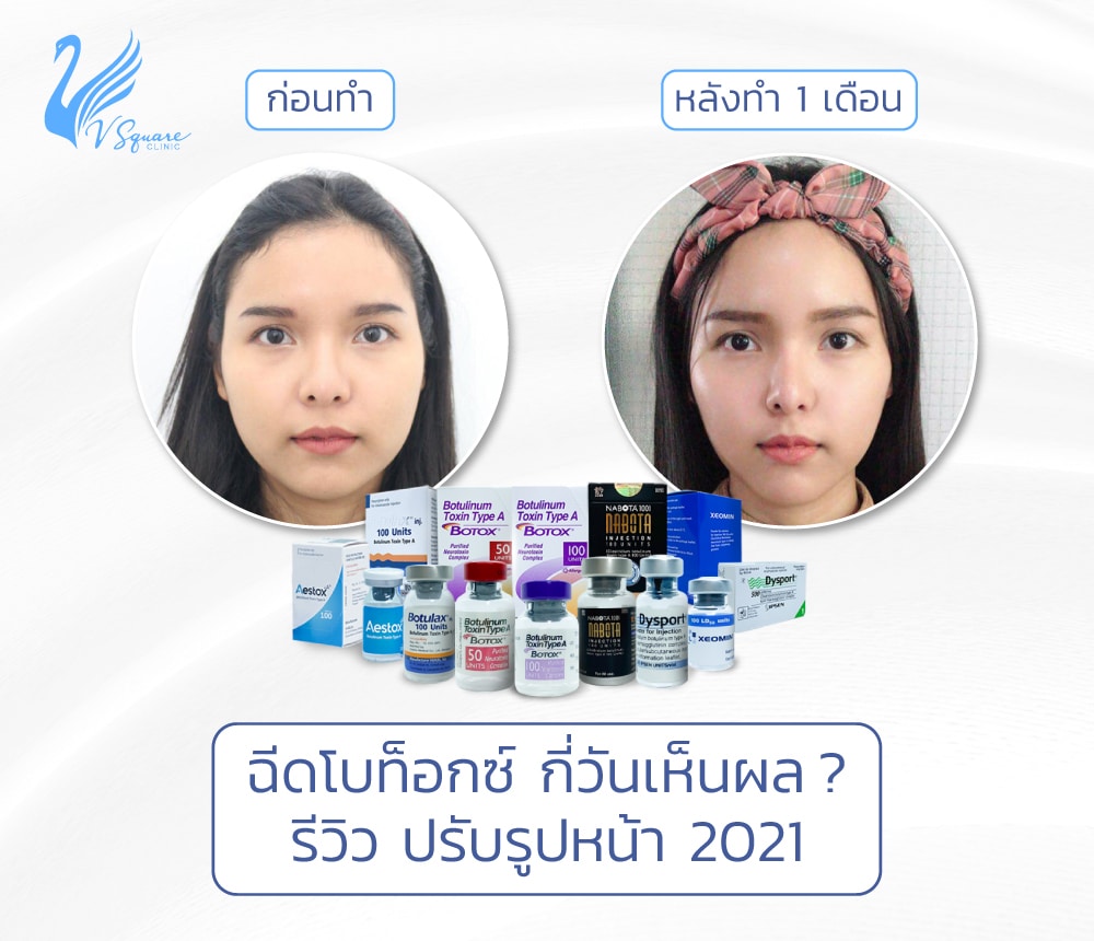 banner-web-ฉีดโบท็อกซ์-กี่วันเห็นผล