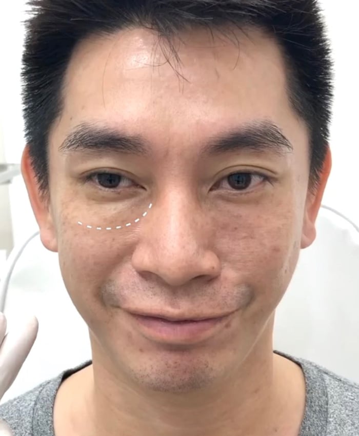 ฉีดฟิลเลอร์ใต้ตาแล้วเป็นก้อน