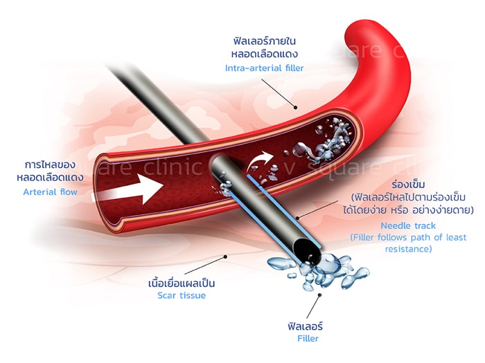 ฉีดสลายฟิลเลอร์-ด้วย-Hyaluronidase