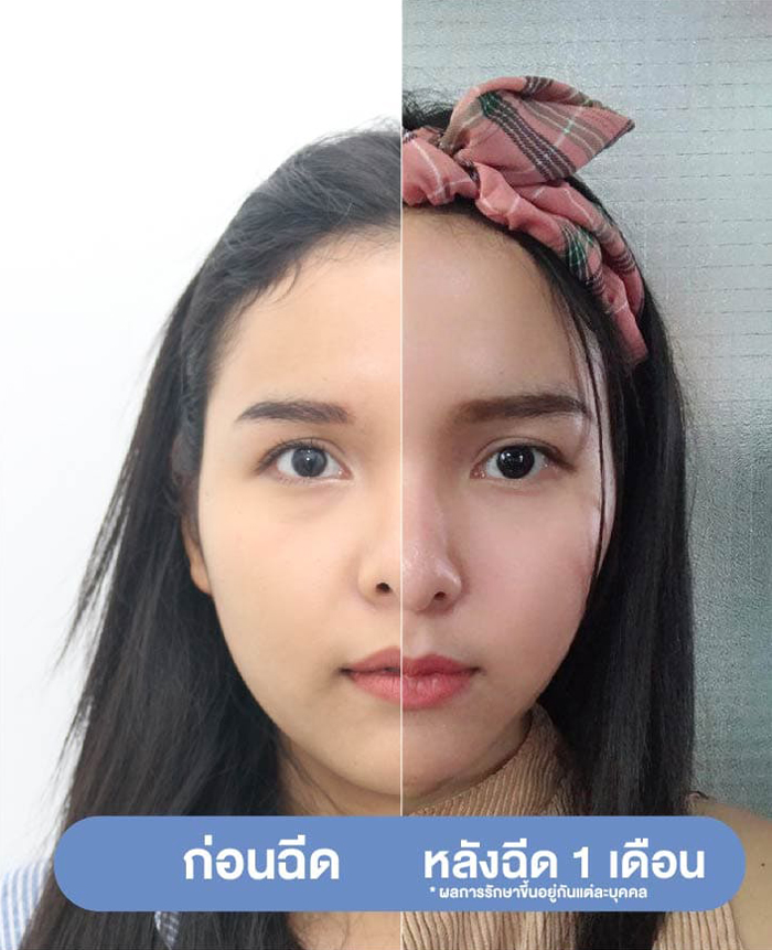 ฉีดโบท็อก-กี่วันเห็นผล