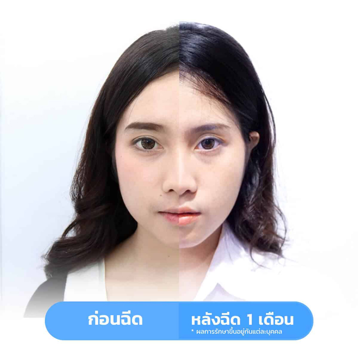 ฉีดโบท็อก-กี่วันเห็นผล