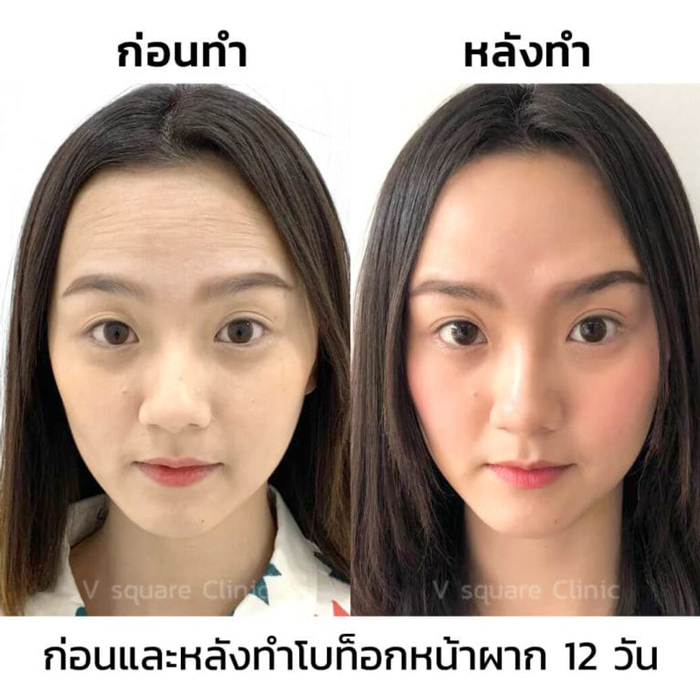 ฉีดโบท็อก-กี่วันเห็นผล