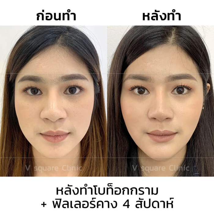 ฉีดโบท็อก-กี่วันเห็นผล