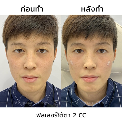 รีวิวฉีดฟิลเลอร์ใต้ตา-2-cc
