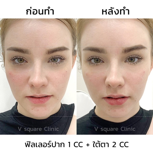 รีวิวฉีดฟิลเลอร์ใต้ตา-2-cc-ฟิลเลอร์ปาก-1-CC