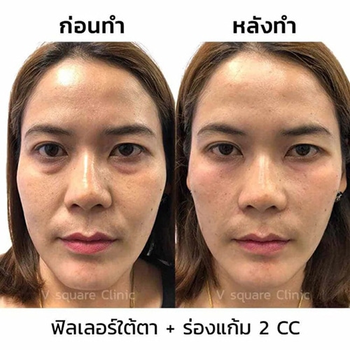 รีวิวฉีดฟิลเลอร์ใต้ตา-ร่องแก้ม-ข้างละ-2-cc