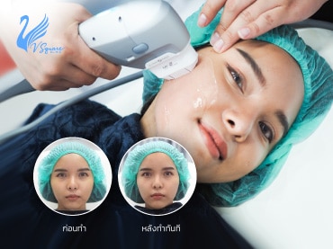 hifu-รีวิว