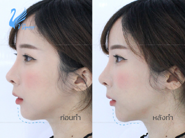 รีวิว-ฉีดฟิลเลอร์คาง-ก่อน---หลัง-ฉีด-ควรรู้อะไรบ้าง