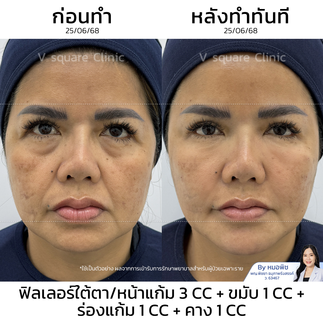 รีวิว ฟิลเลอร์ร่องแก้ม คุณหนิง