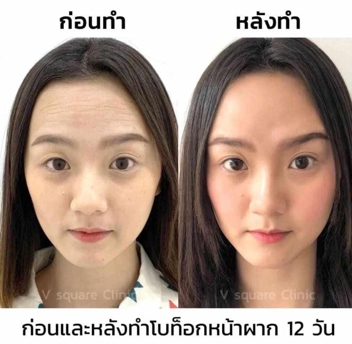 รีวิวฉีดโบลดริ้วรอย