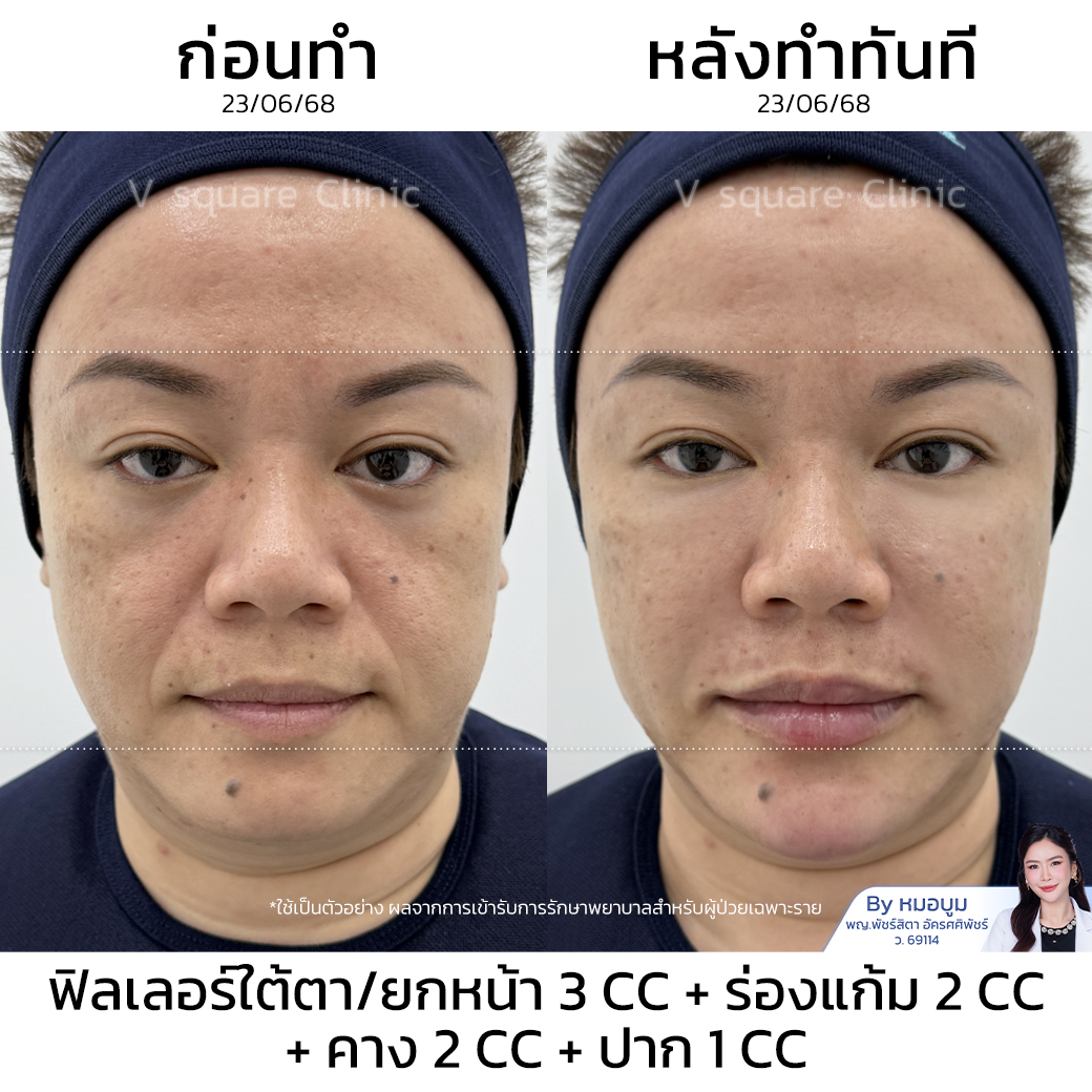 รีวิวฟิลเลอร์ร่องแก้ม คุณปาย (แบบเบสๆ)