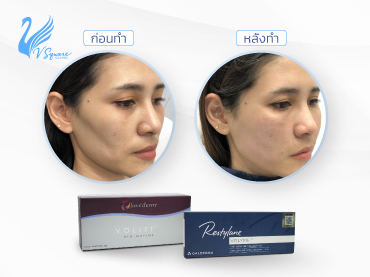 รูปบทความ_ฟิลเลอร์แก้มตอบ-คืนความอ่อนเยาว์ให้ใบหน้า-แลดูสวยอย่างเป็นธรรมชาติ