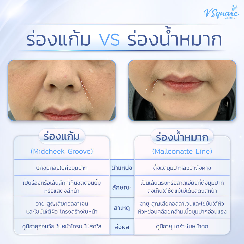 ร่องแก้ม ร่องน้ำหมาก ต่างกันอย่างไร