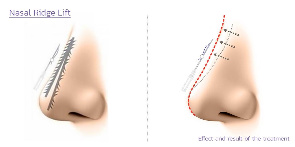 ภาพจำลองการร้อยไหมจมูก