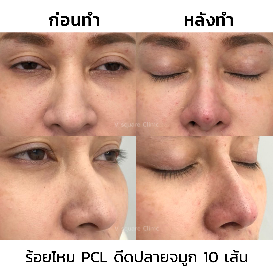 ร้อยไหมจมูกรีวิว