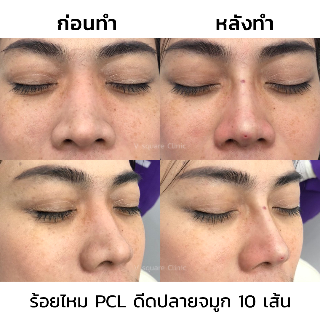 ร้อยไหมจมูกรีวิว