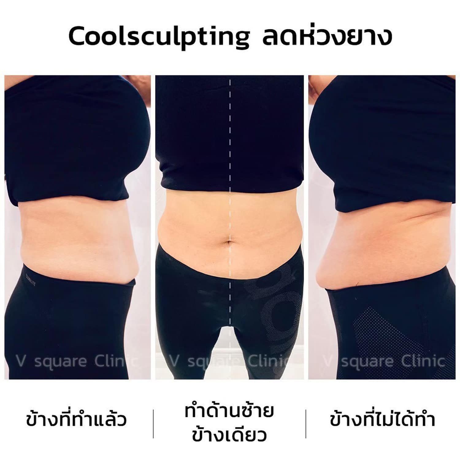 CoolSculpting-ลดไขมันหน้าท้อง