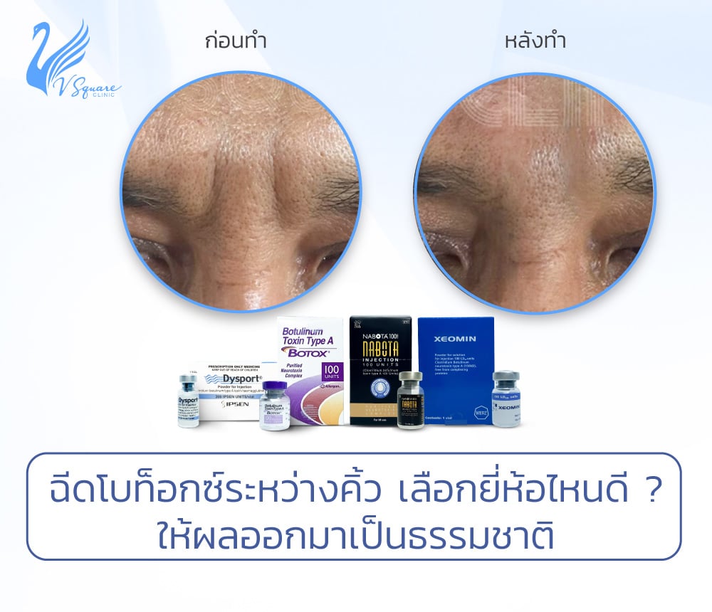 ฉีดโบท็อกระหว่างคิ้ว