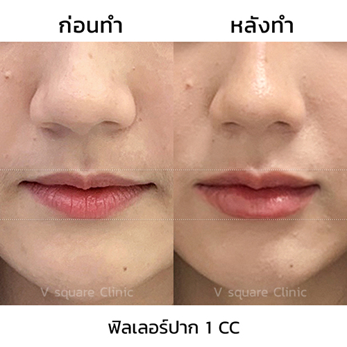 รีวิวฉีดฟิลเลอร์ปาก