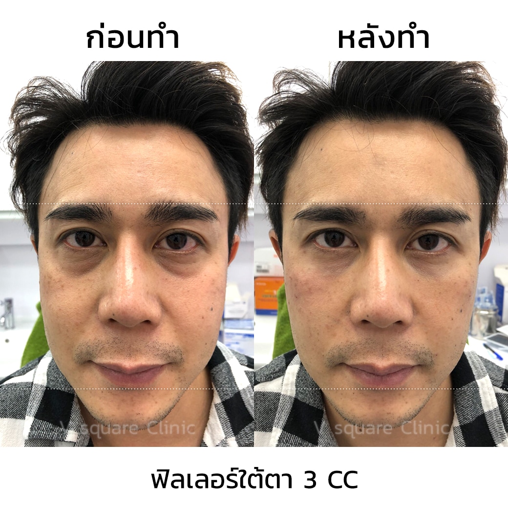 รีวิวฉีดฟิลเลอร์ใต้ตา 3 cc