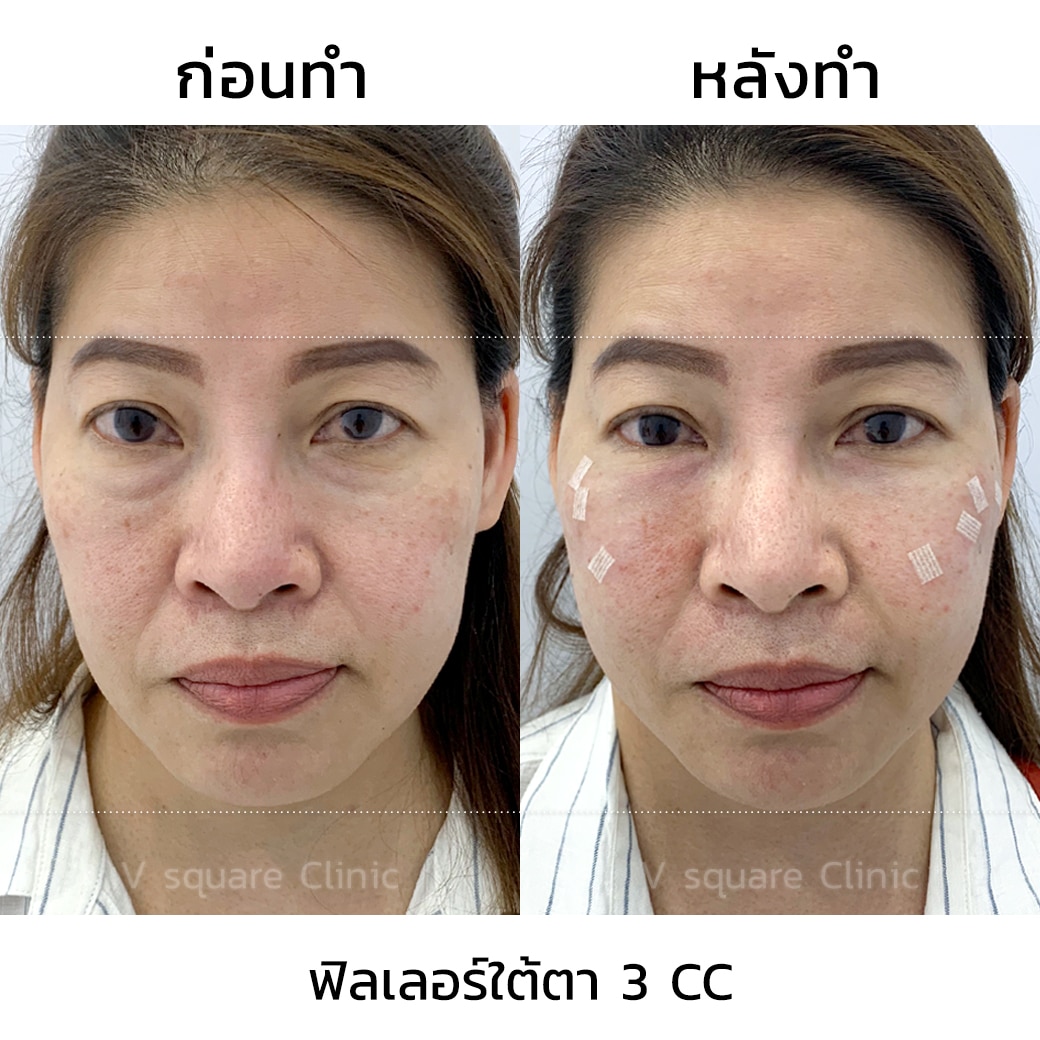 รีวิว before-after การฉีดฟิลเลอร์