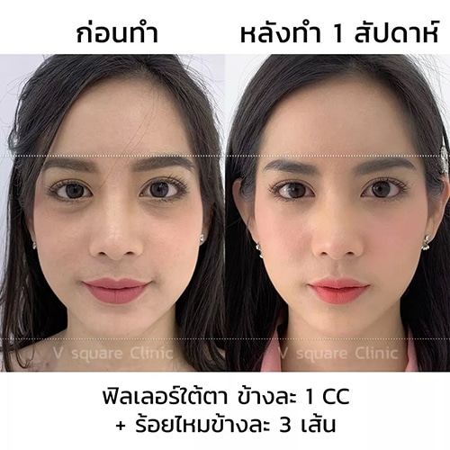 รีวิวฟิลเลอร์ใต้ตา-1-cc-ร้อยไหมข้างละ-3-เส้น