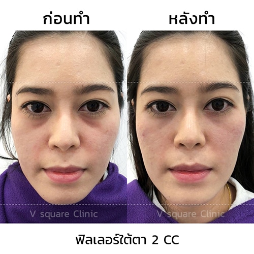 รีวิวฟิลเลอร์ใต้ตา-2-cc