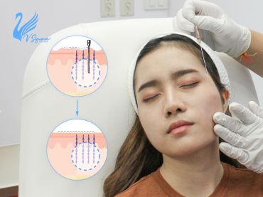 รูปปกบทความ_ร้อยไหม-ยกกระชับ-ตัวช่วยคืนความอ่อนเยาว์