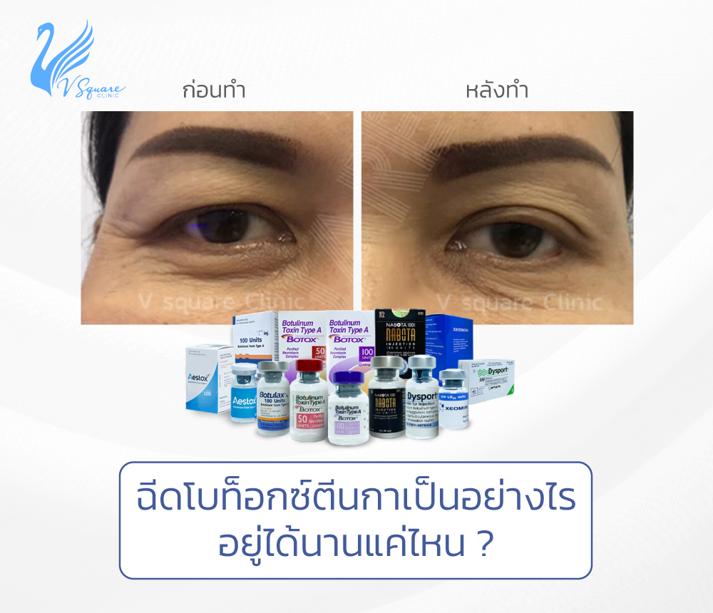 banner-web-ฉีดโบท็อกตีนกา