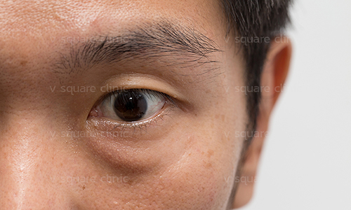 ฉีดฟิลเลอร์แล้วเป็นก้อน