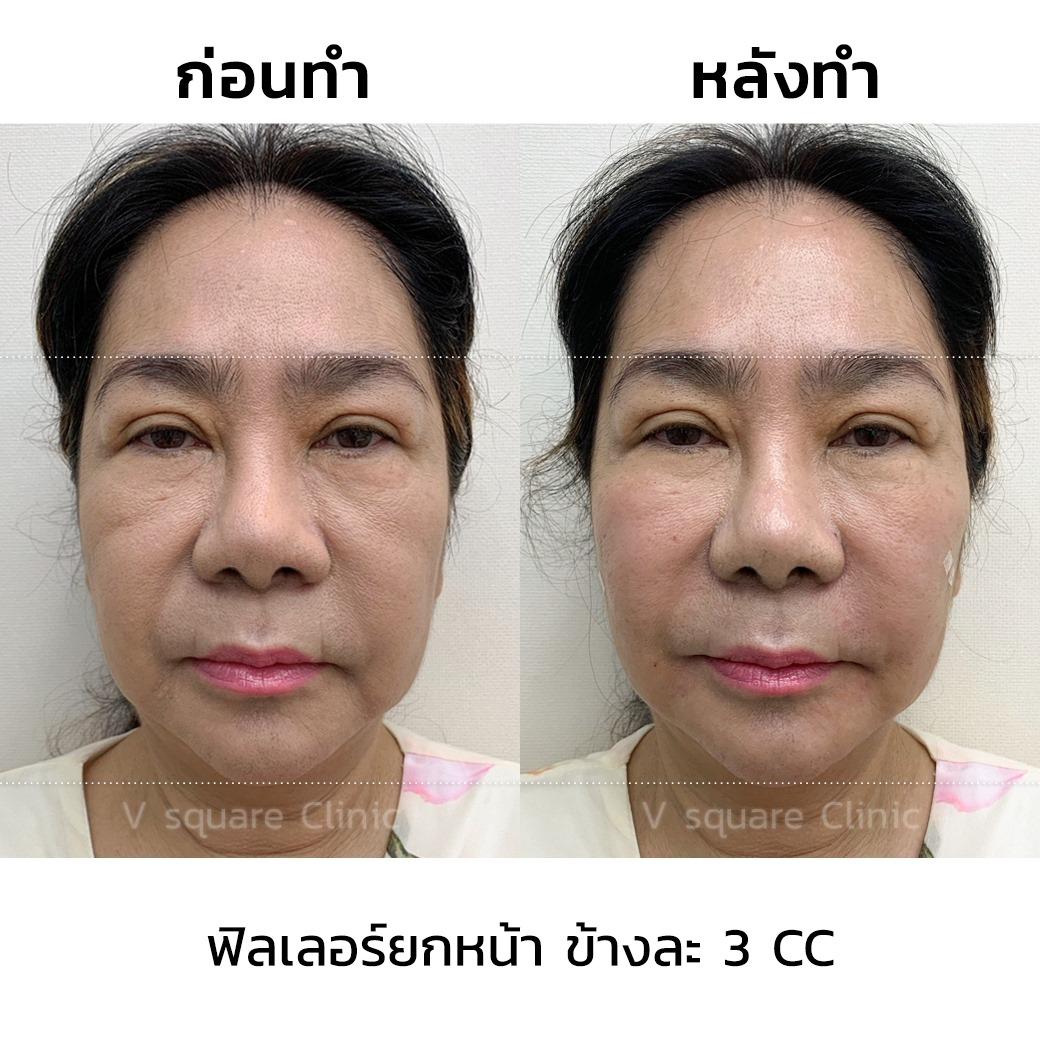 ฟิลเลอร์ Belotero รีวิว