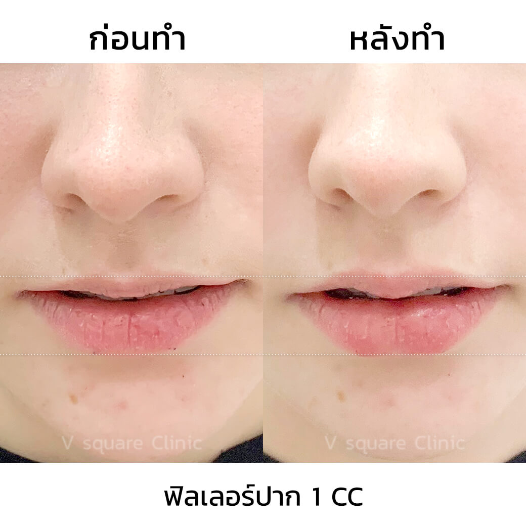 รีวิวฉีดฟิลเลอร์เห็นผลทันทีหลังทำ