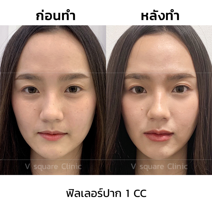 รีวิวฟิลเลอร์ปาก