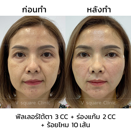 รีวิวฟิลเลอร์ใต้ตา+ร่องแก้ม+ร้อยไหม