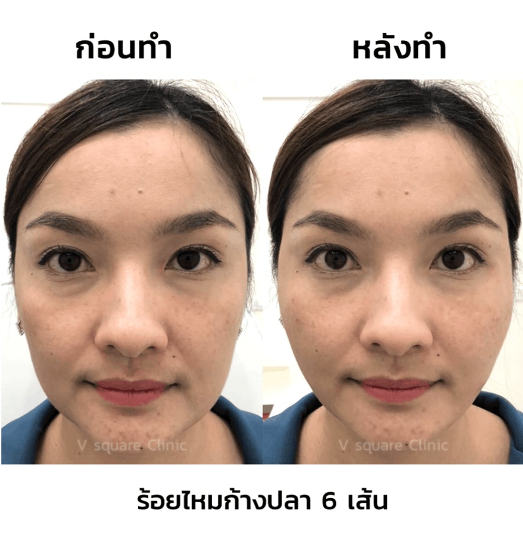 รีวิวร้อยไหมก้างปลา-6-เส้น