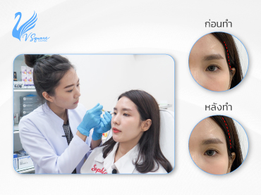 รีวิวฟิลเลอร์ขมับ