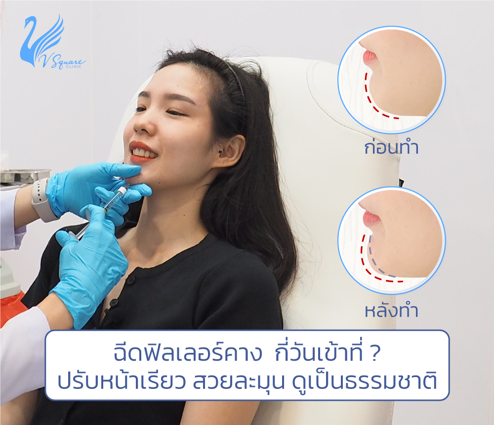 ฉีดฟิลเลอร์คางบวมกี่วัน