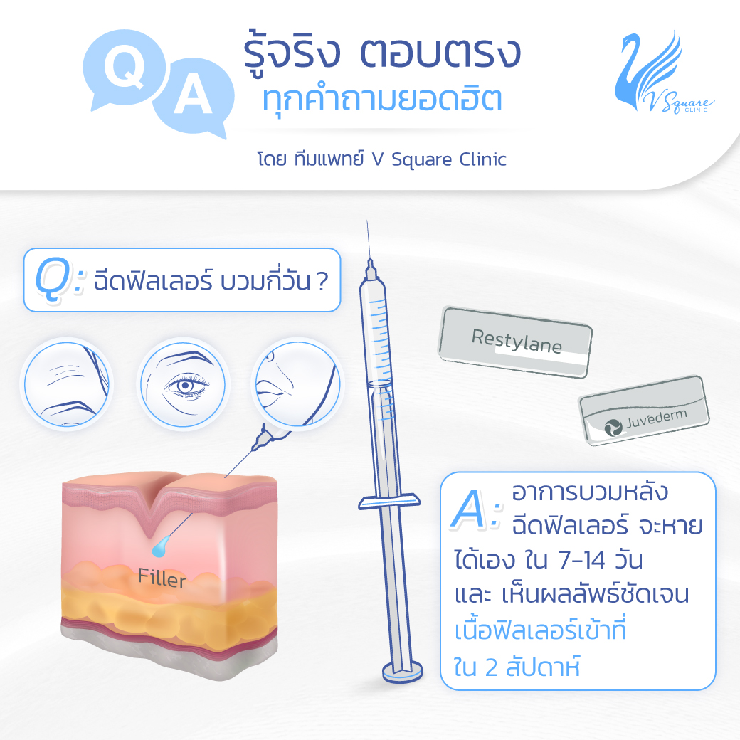 ฉีดฟิลเลอร์บวมกี่วัน