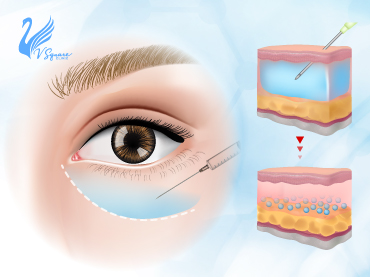 รูปปกบทความ_ฉีดสลายฟิลเลอร์ใต้ตา