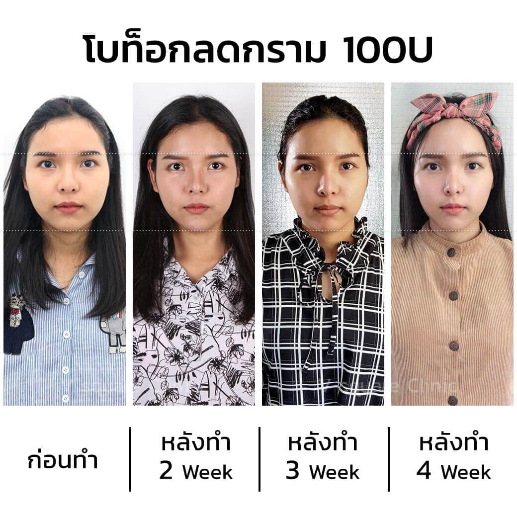รีวิวฉีดโบท็อก botulax หน้าเรียว