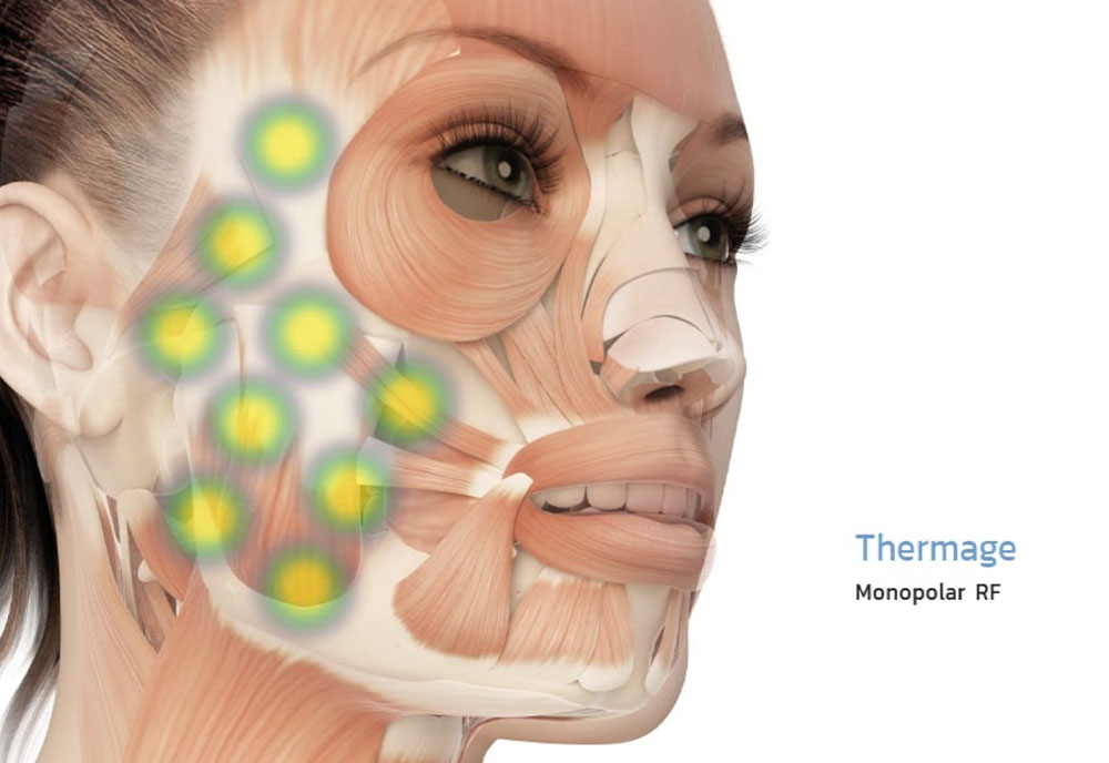 thermage