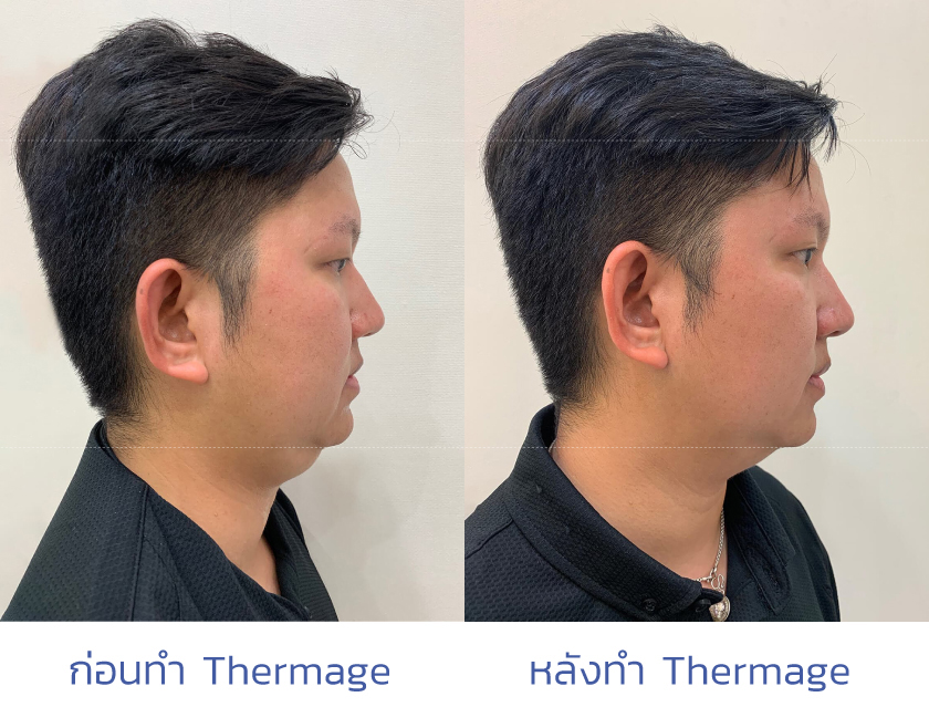 thermage before after