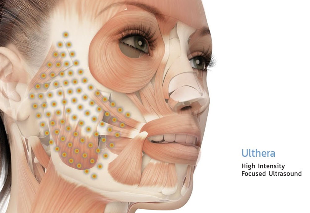 ulthera