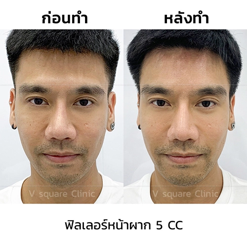 รีวิว-ฉีดฟิลเลอร์หน้าผาก ด้านหน้า พี่พีช