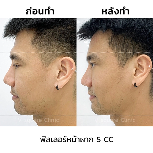 รีวิวเคสฉีดฟิลเลอร์หน้าผาก_2 พี่พีช