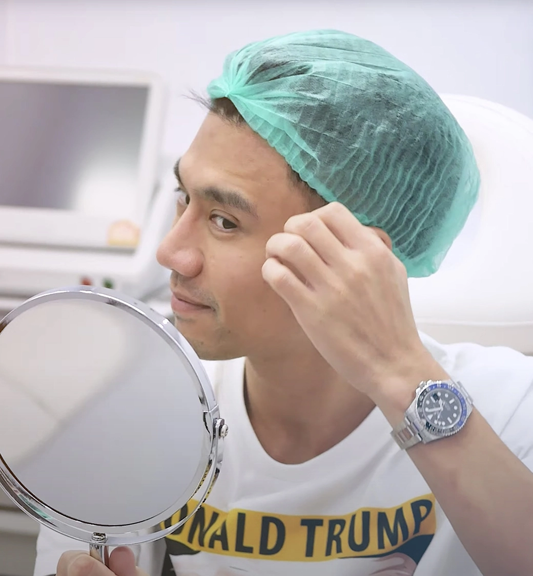 หลังฉีดฟิลเลอร์หน้าผาก พี่พีช