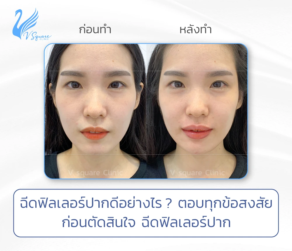 การฉีดฟิลเลอร์ปาก